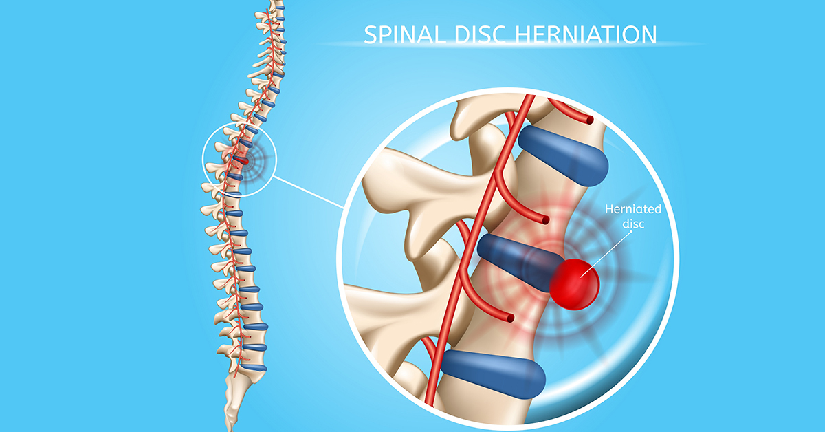 Guide, Physical Therapy Guide to Herniated Disk